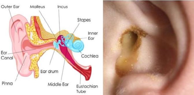 How To Cure An Ear Infection In Adults Naturally How To Cure An Ear Infection In Adults Naturally
